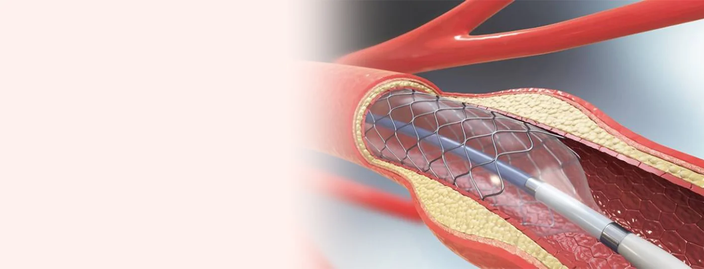 Life After Angioplasty: 5 Essential Tips to Prevent Stent Re-Blockage in 2026